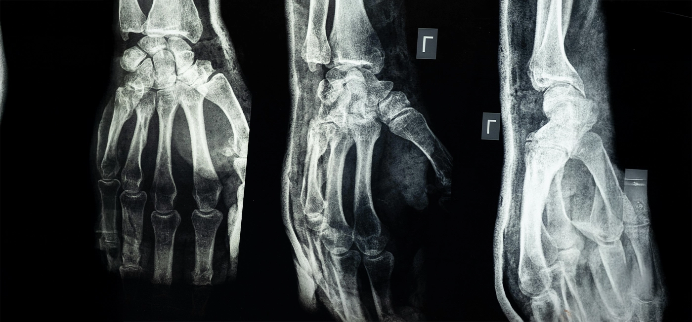 Chine : une colle osseuse révolutionnaire répare les fractures en seulement trois minutes 3 Radiographie en noir et blanc montrant différentes vues des os de la main et du poignet avec fracture apparente.