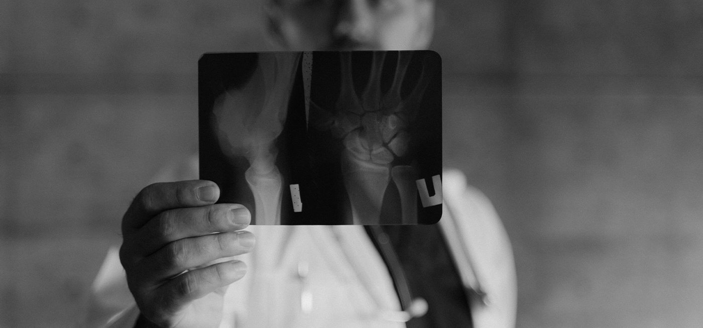 Chine : une colle osseuse révolutionnaire répare les fractures en seulement trois minutes 2 Médecin tenant une radiographie en noir et blanc du poignet, mettant en évidence une fracture osseuse.